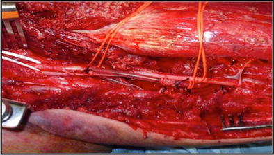 Damage Control Vascular Surgery In The Austere Environment - 