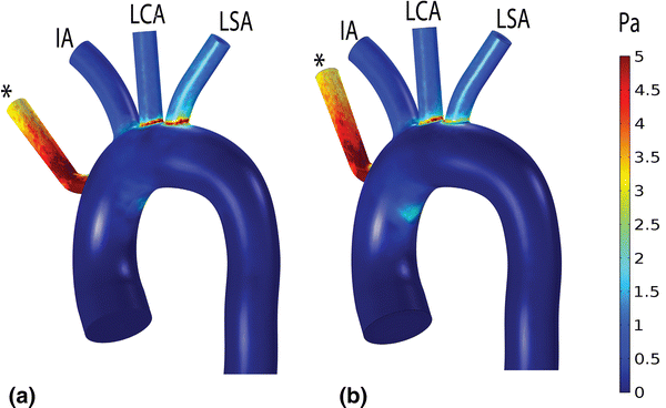 Influence of Aortic Outflow Cannula Orientation on Epiaortic Flow ...