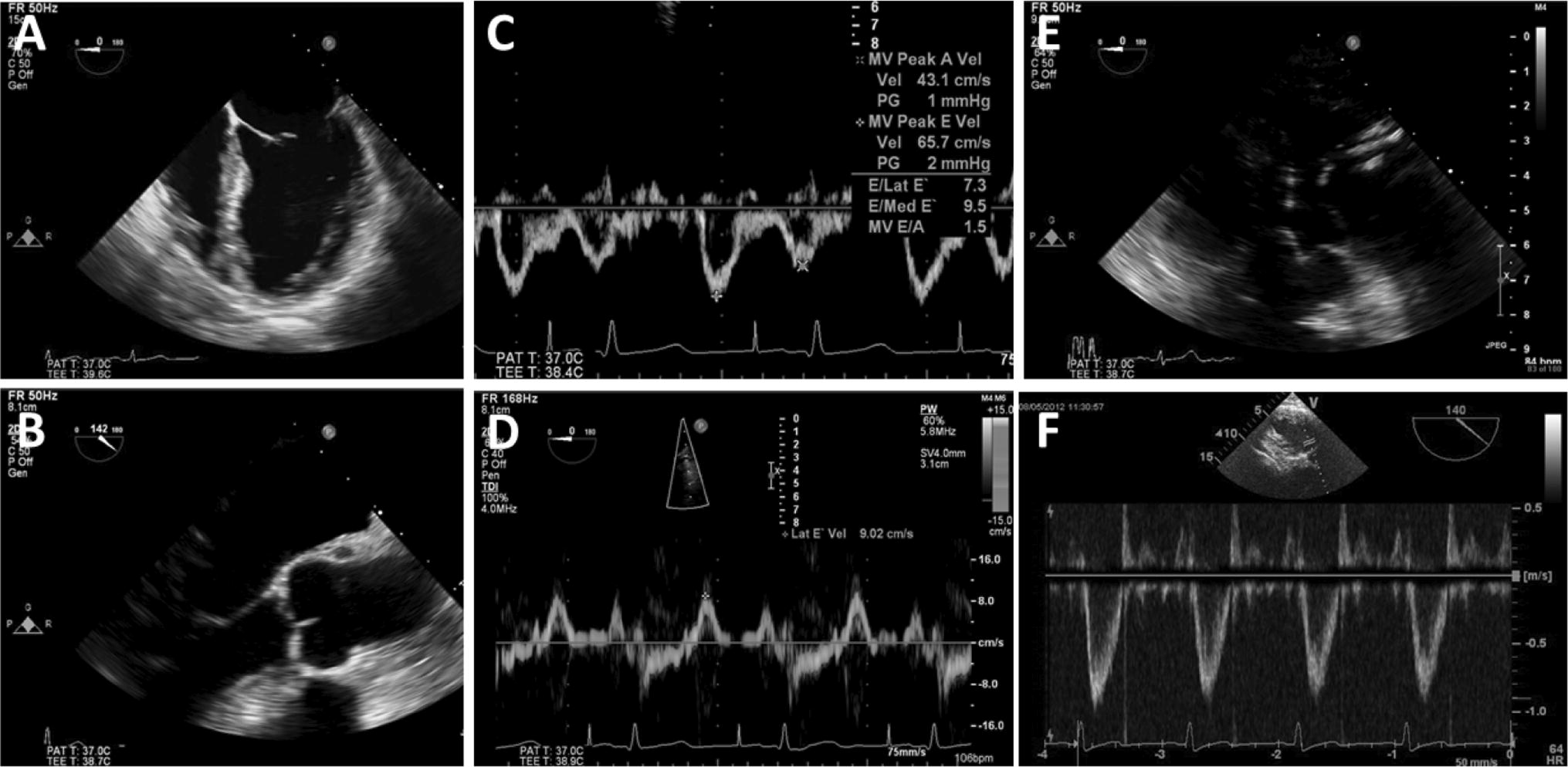 of e properties tee plane invasive Mechanical Properties of Aortic Non Determination of e properties tee plane invasive Mechanical Properties of Aortic Non Determination