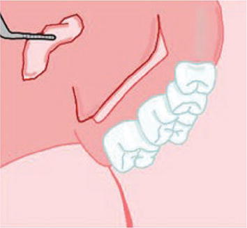 Harvesting Of Autogenous Grafts For Gingival Recession Coverage