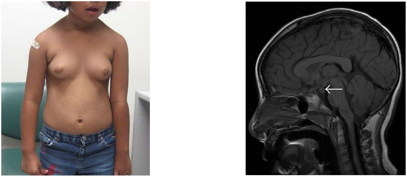 breast-development-of-a-teenage-girl