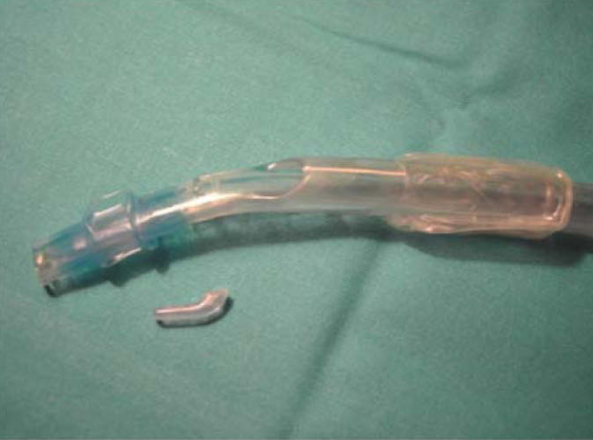 "Detachment of the carinal hook following endobronchial intubation with