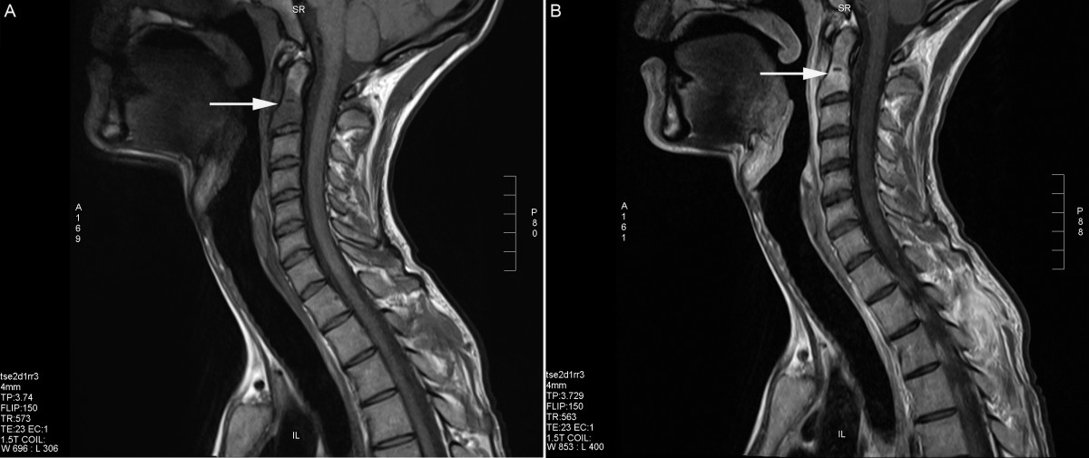Osteitis in the dens of axis caused by Treponema pallidum SpringerLink