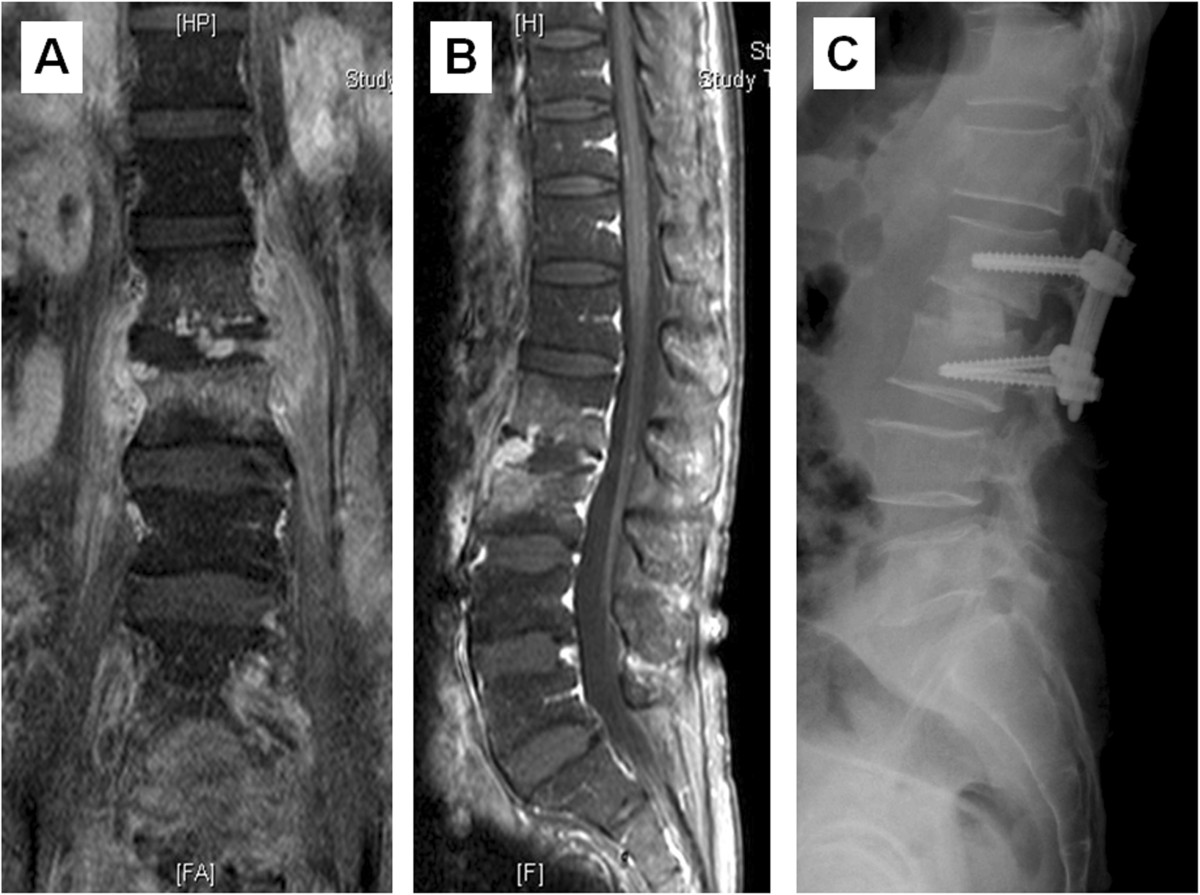 Comparison Of Two Stage Open Versus Percutaneous Pedicle Screw