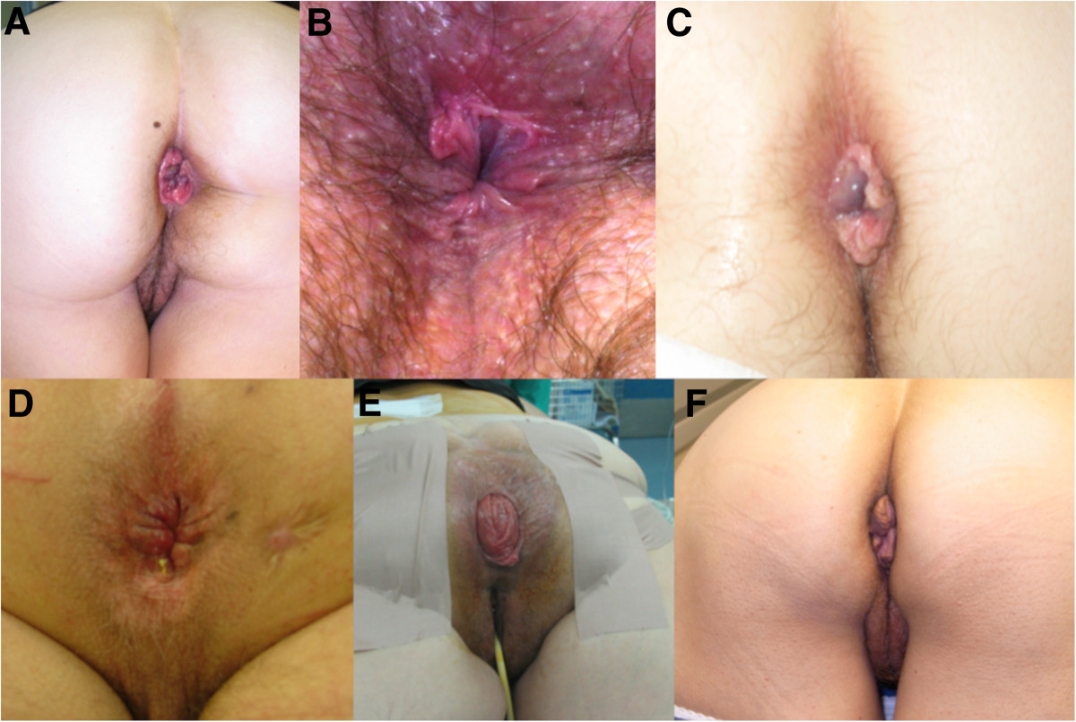 What To Do If You Have Anal Fistula.