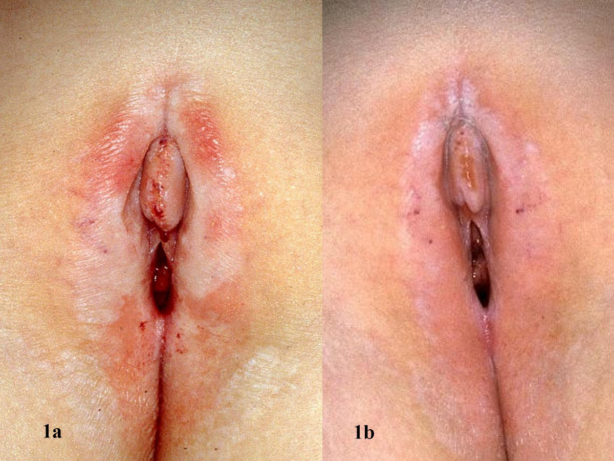 Rash natal cleft vulva perineum