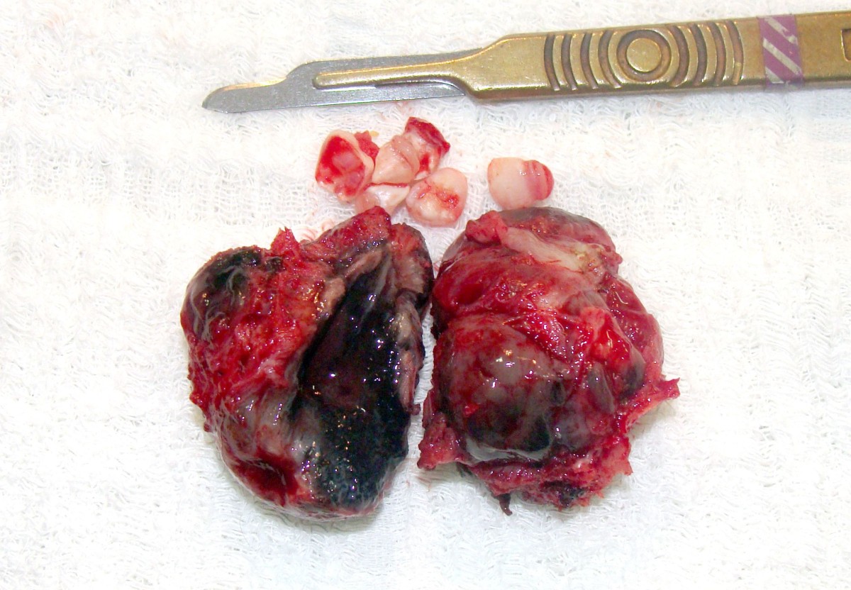 Melanotic neuroectodermal tumor of infancy in an African-indigenous patient  from the Amazon: a case report
