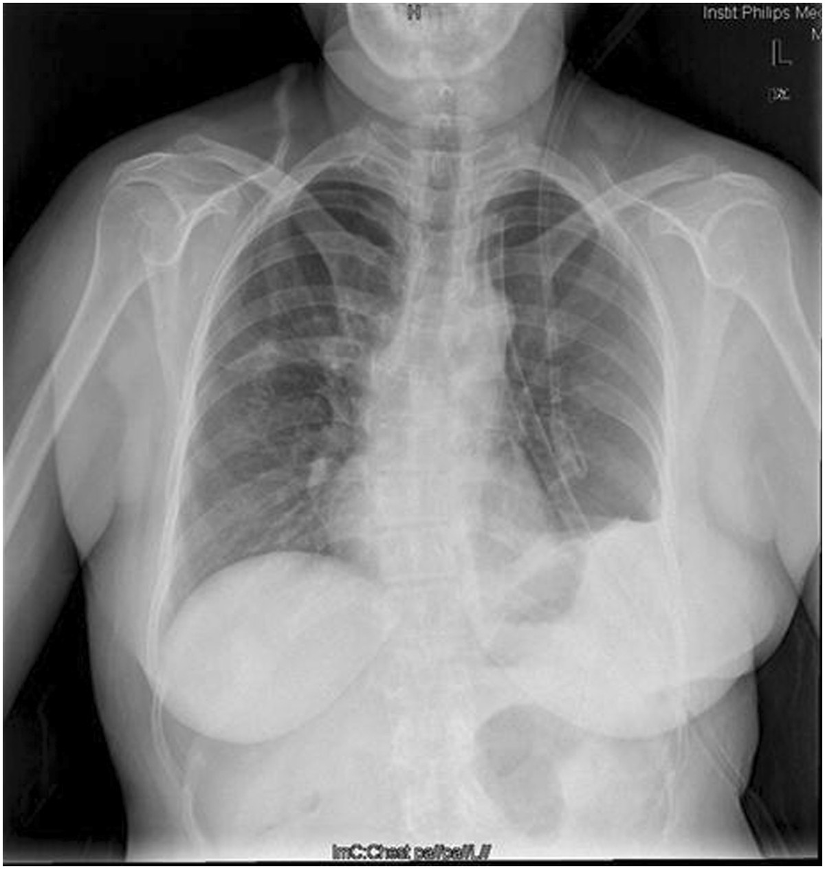 Giant congenital diaphragmatic hernia in an adult | SpringerLink Giant congenital diaphragmatic hernia in an adult | SpringerLink