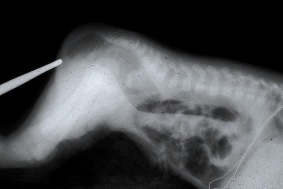 precise-calibrated-anal-sphincter-dilatation-tapes