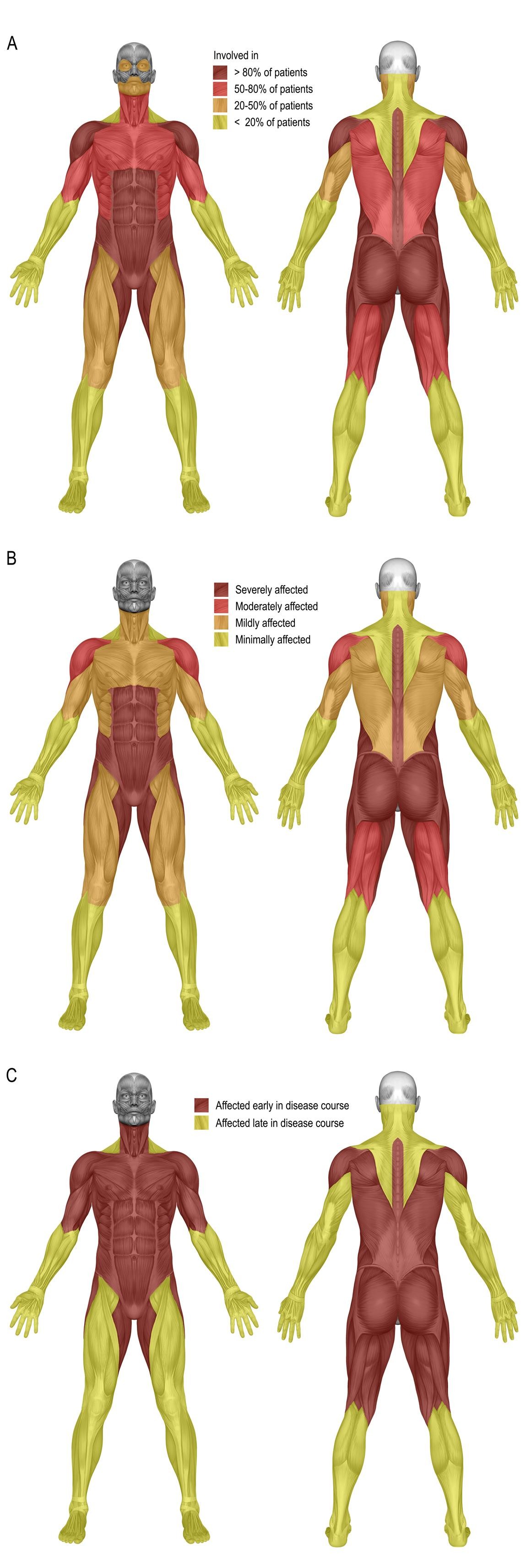 tackling muscle weakness with progesterone als Dermatomyositis is a rare inflammatory disease common symptoms of dermatomyositis include a distinctive skin rash, muscle weakness, and inflammatory myopathy, or inflamed muscles. tackling muscle weakness with progesterone als Dermatomyositis is a rare inflammatory disease common symptoms of dermatomyositis include a distinctive skin rash, muscle weakness, and inflammatory myopathy, or inflamed muscles.