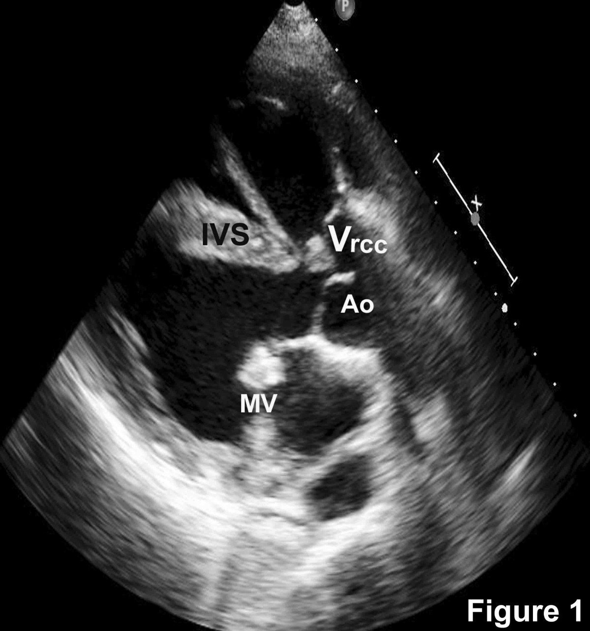 Tetralogy of Fallot with rheumatic mitral stenosis: A case report ...