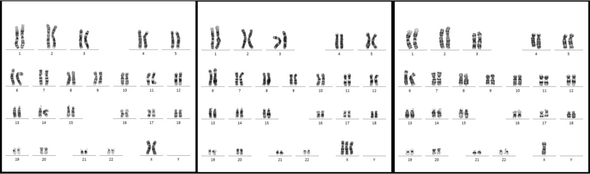 mosaic turner syndrome mosaic turner syndrome