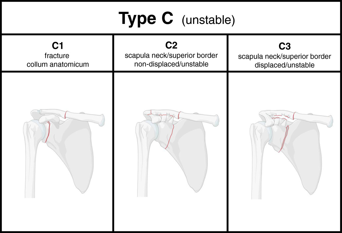 Scapula fractures in complex shoulder injuries and floating shoulders