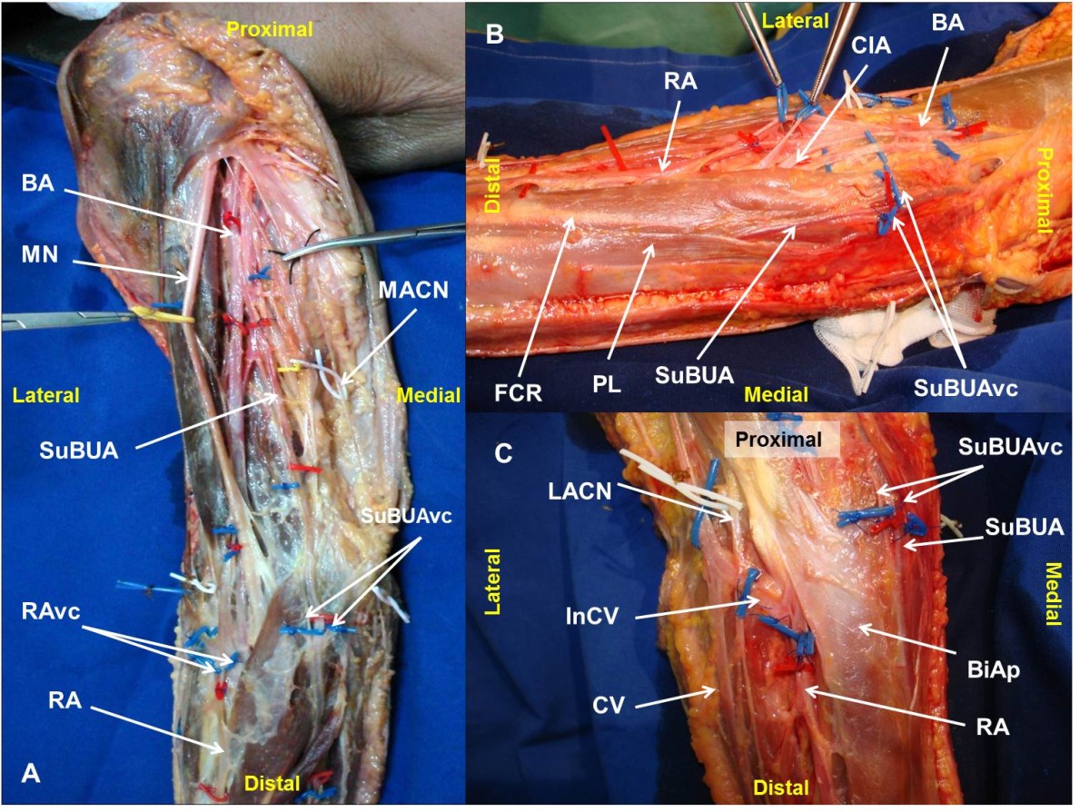 A rare variant of the ulnar artery with important clinical implications