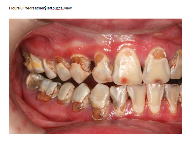 arresting rampant dental caries with silver diamine fluoride in a rampant caries