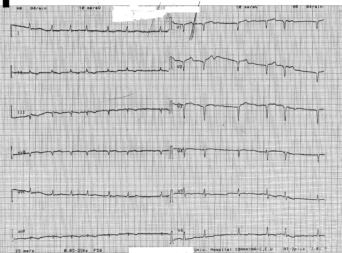 Programmed inappropriate ICD ventricular defibrillation for cardioversion of persistent atrial ...