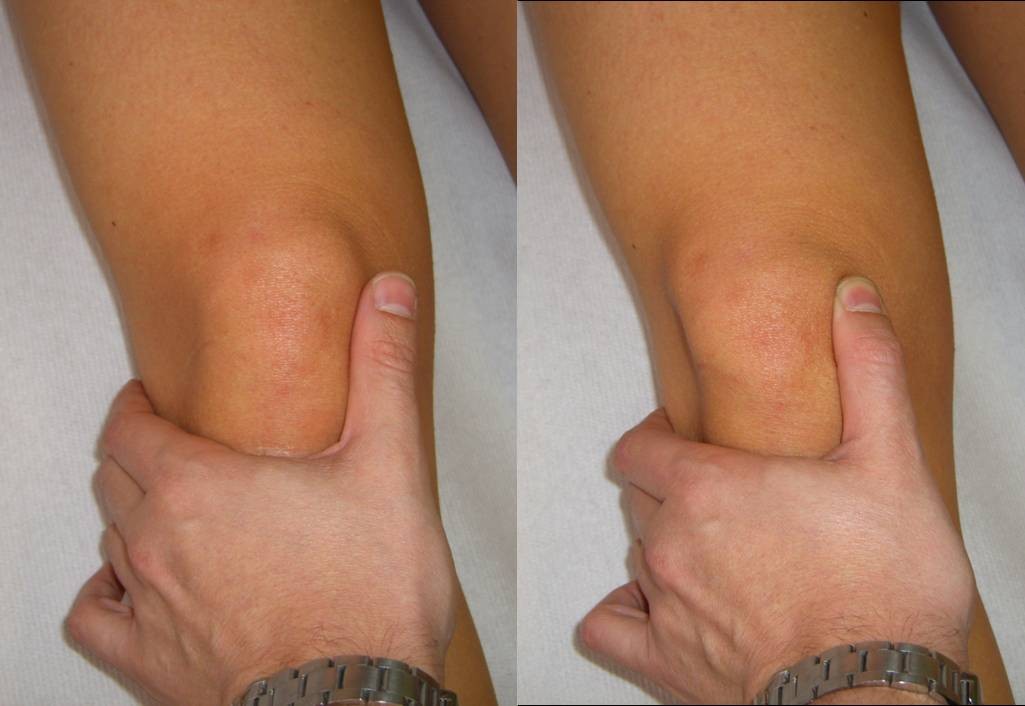 Clinical Examination Of The Knee Know Your Tools For Diagnosis Of