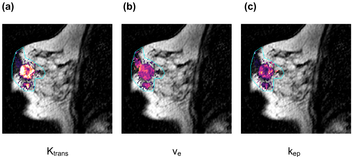 development of dynamic contrast enhanced mri Future science group wwwfuturemedicinecom 175 dynamic contrast-enhanced mri in cancer review reports of nephrogenic systemic fibrosis linked to the use of high doses of gd-based contrast. development of dynamic contrast enhanced mri Future science group wwwfuturemedicinecom 175 dynamic contrast-enhanced mri in cancer review reports of nephrogenic systemic fibrosis linked to the use of high doses of gd-based contrast.