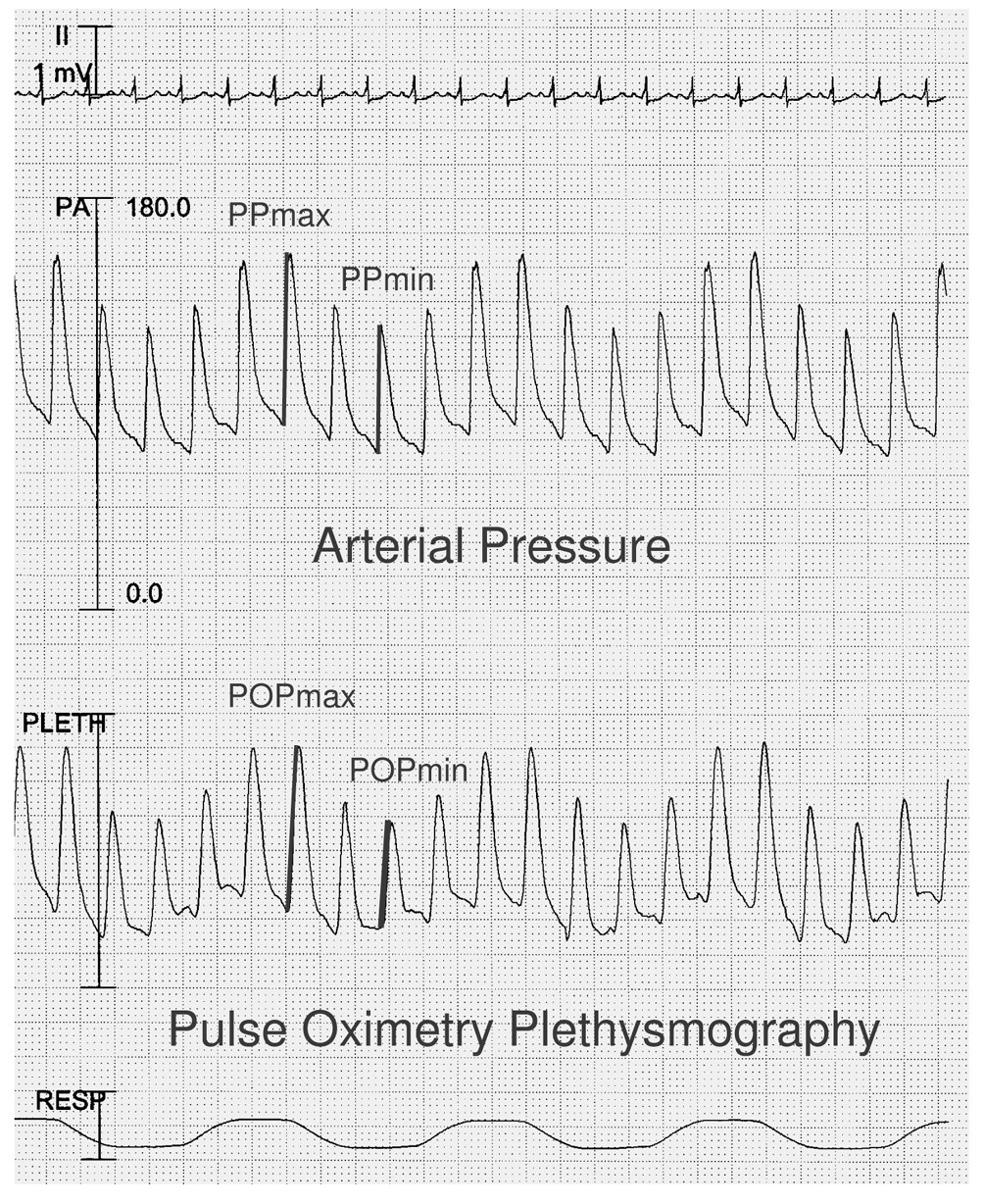 Relation between respiratory variations in pulse oximetry plethysmographic waveform amplitude