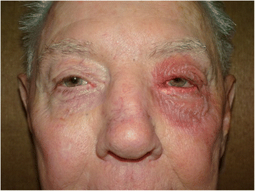 Neomycin, polymyxin B, and dexamethasone allergic reactions following