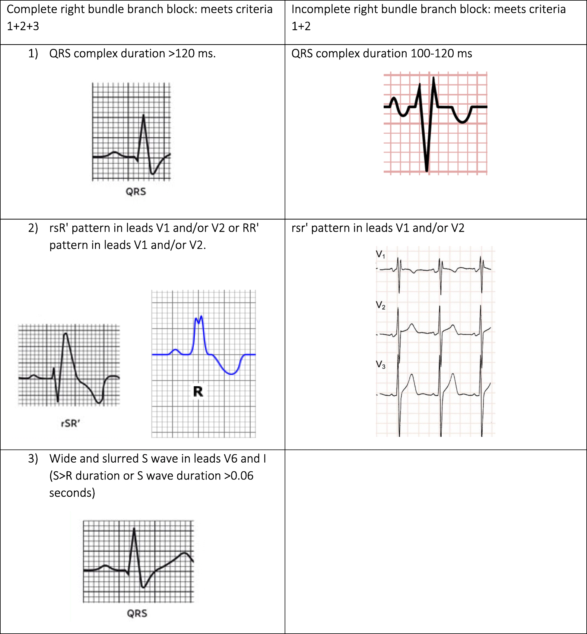 diagnosis of right bundle branch block a concordance study rbbb ecg