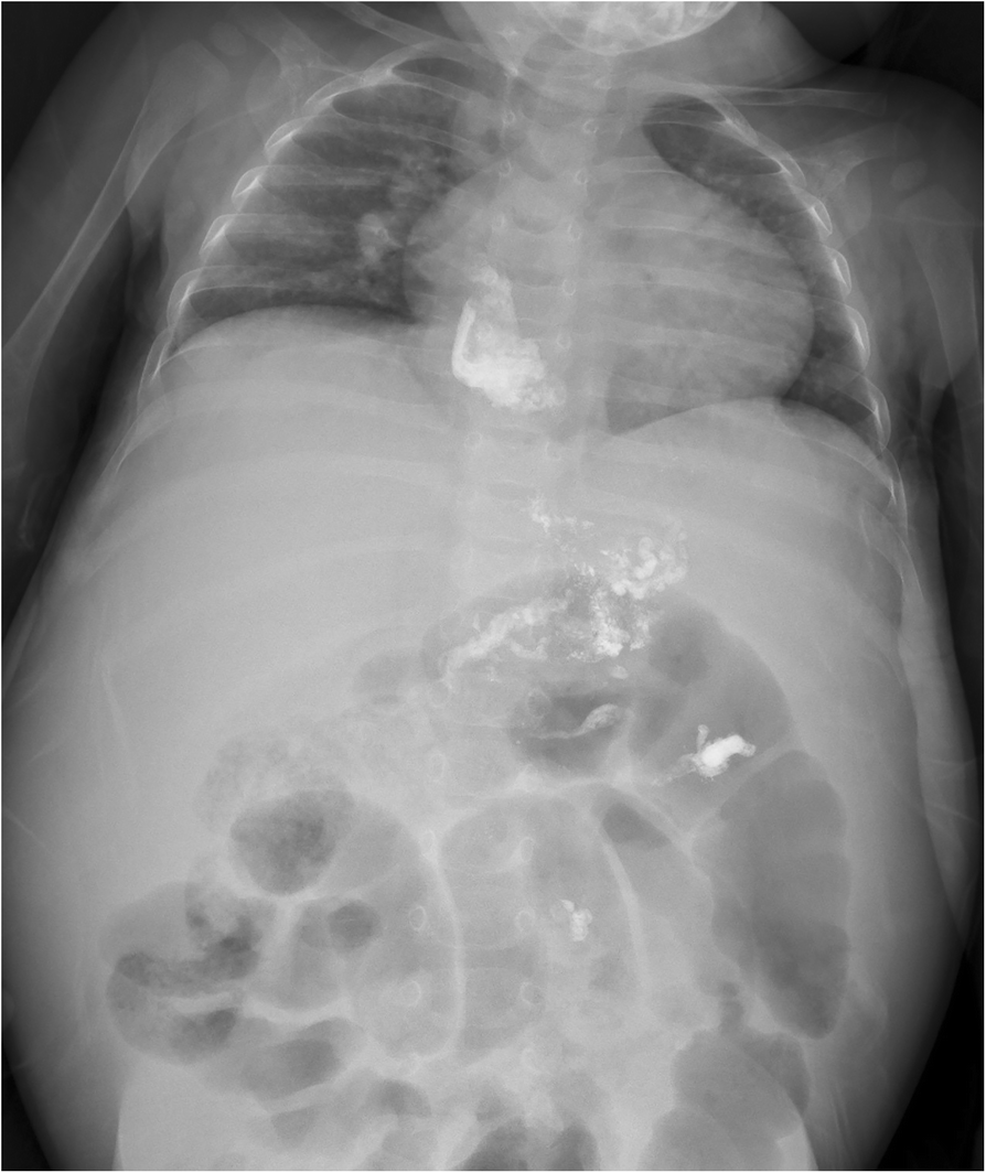 Endoscopic injection sclerotherapy for pediatric bleeding esophageal