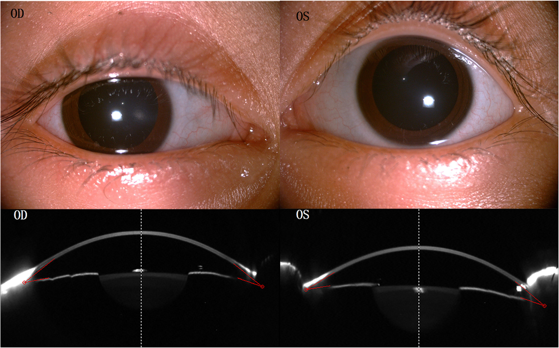 Brittle cornea syndrome a case report and review of the literature