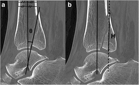 Morphological Characteristics Of The Posterior Malleolar