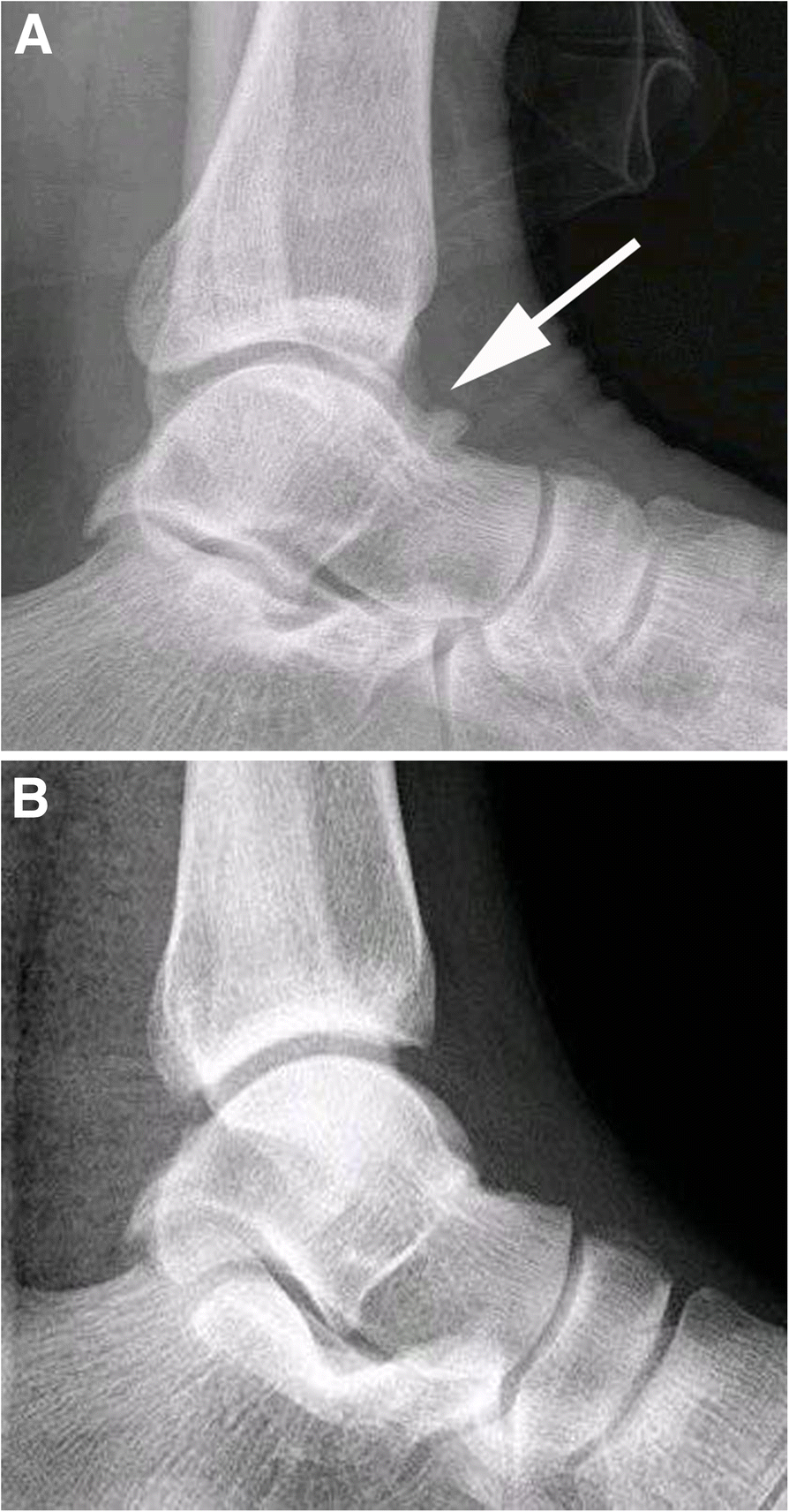 Arthroscopic Debridement Of Anterior Ankle Impingement In Patients