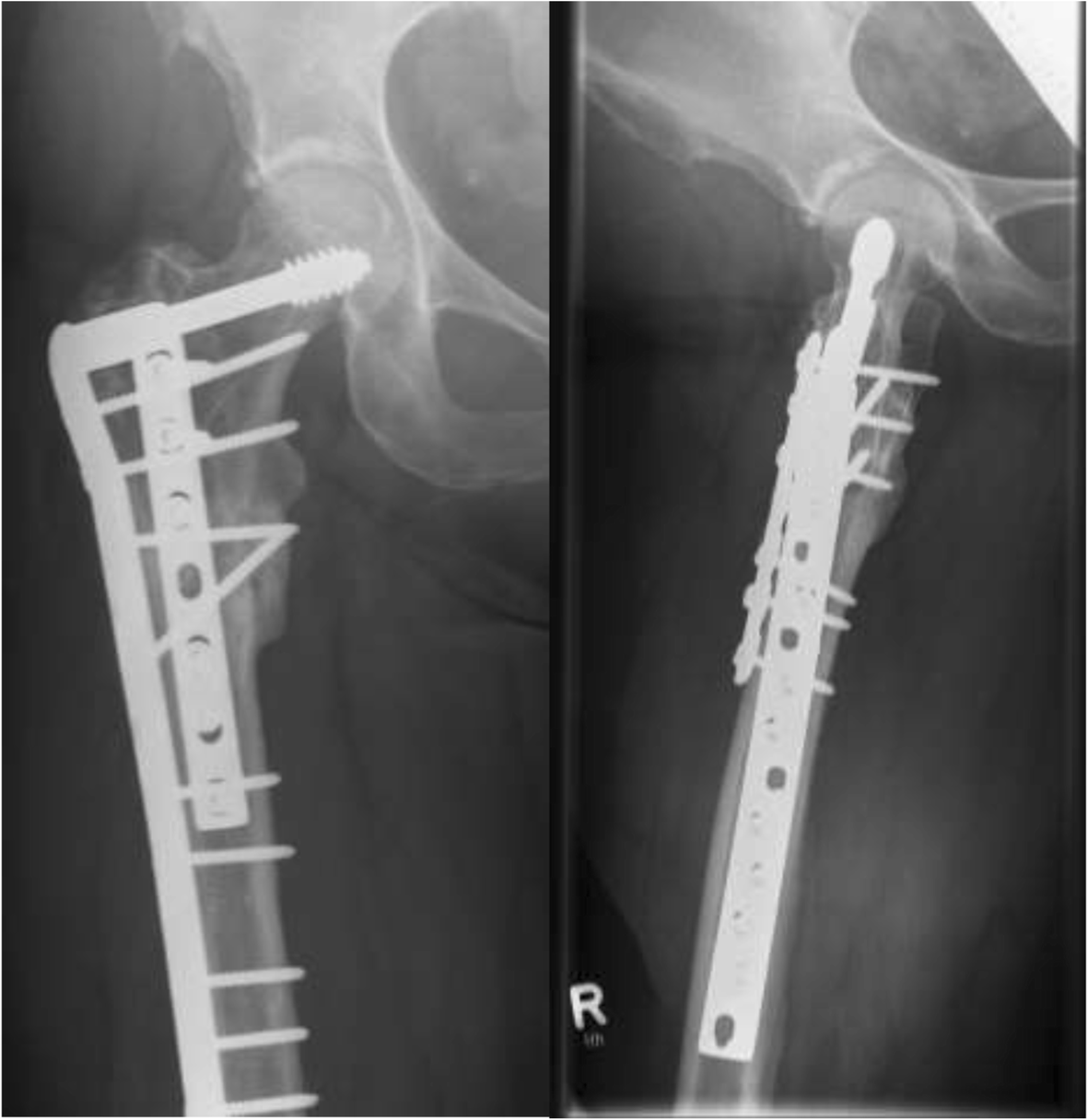 Gamma Nail Surgery Recovery Nail Ftempo