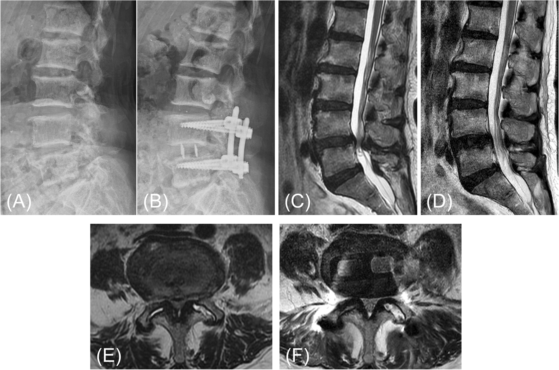 Comparison Of Radiological Changes After Single Position Versus
