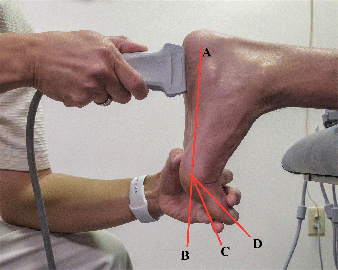 Metatarsophalangeal joint extension changes ultrasound