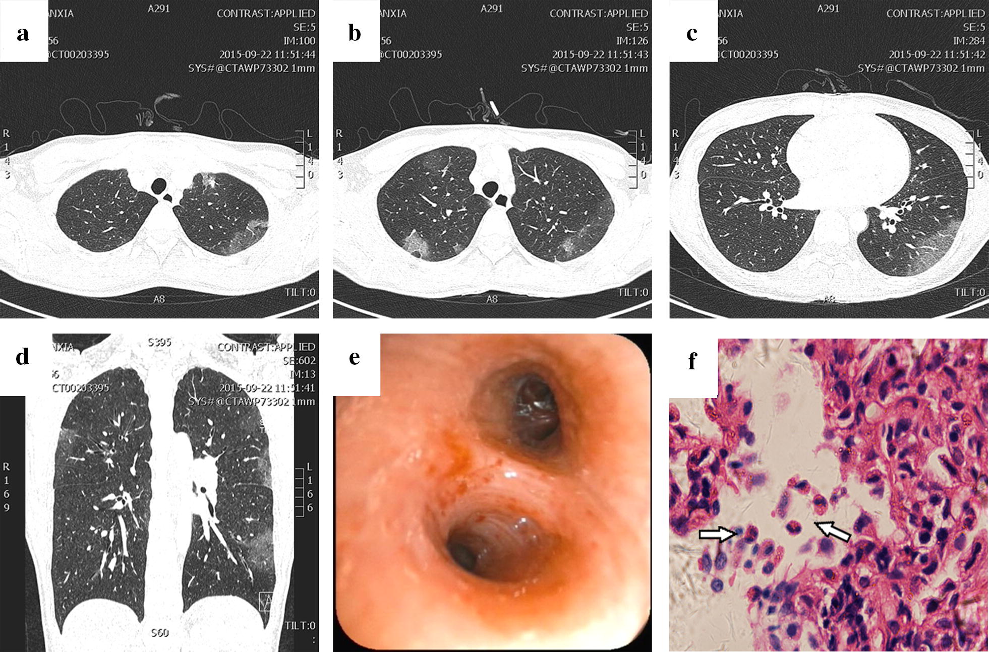 Shortterm pulmonary infiltrate with eosinophilia caused by asthma a