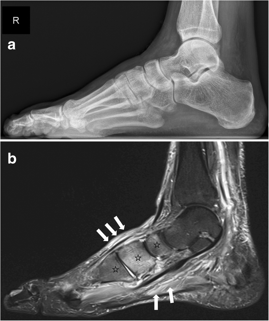 The Charcot foot: a pictorial review | SpringerLink
