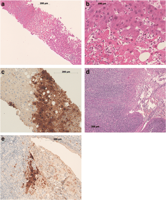 Liver Failure Necrosis