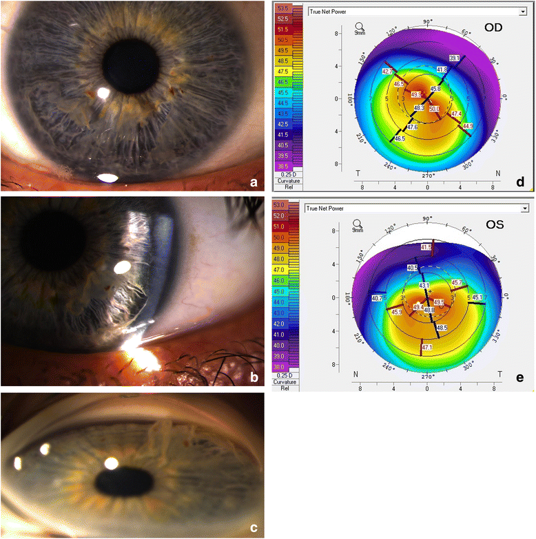 Iridoschisis and keratoconus in a patient with severe allergic eye