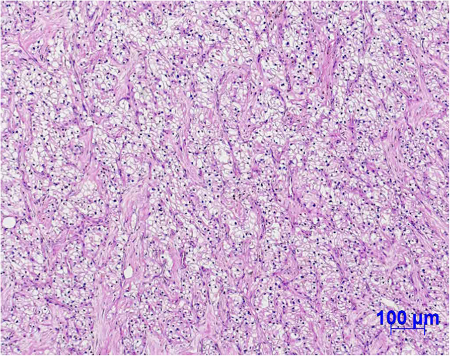 Lowdose axitinib rechallenge with positive in a