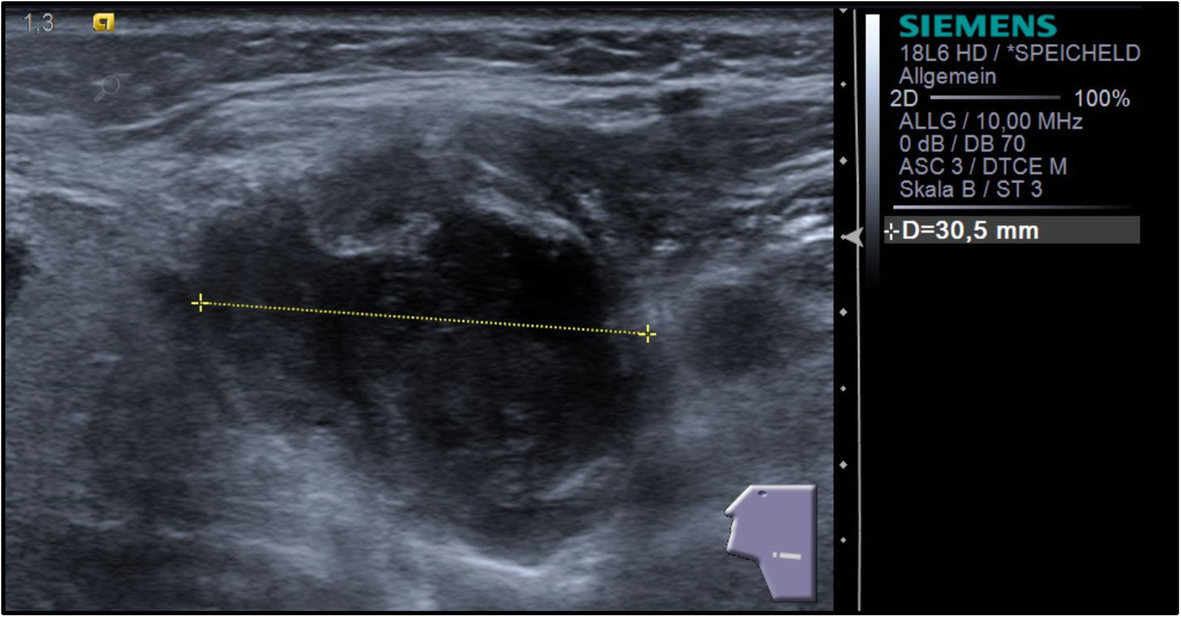 Lymph node abscess caused by Francisella tularensis a rare
