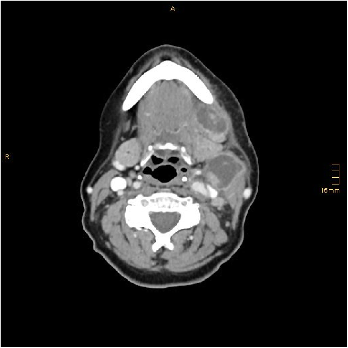 Lymph node abscess caused by Francisella tularensis a rare