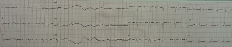 Electrocardiographic changes caused by lithium intoxication in an ...