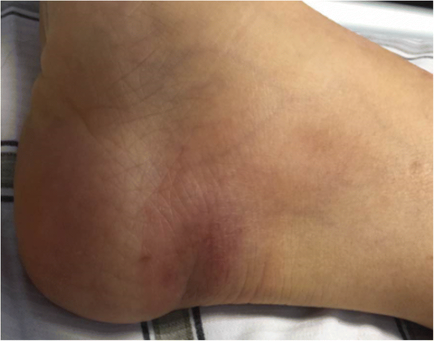 Trypanosoma Brucei Rhodesiense Infection In A Chinese - 