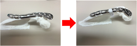 wave-plate osteosynthesis Anterior plating as a surgical alternative in the treatment anterior plating as a surgical alternative in the treatment of of a wave plate osteosynthesis. wave-plate osteosynthesis Anterior plating as a surgical alternative in the treatment anterior plating as a surgical alternative in the treatment of of a wave plate osteosynthesis.