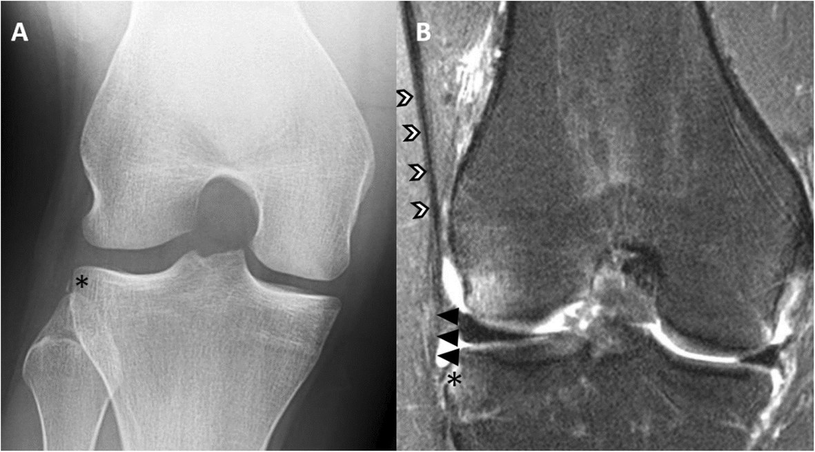 Diagnosis And Treatment Of Rotatory Knee Instability Springerlink