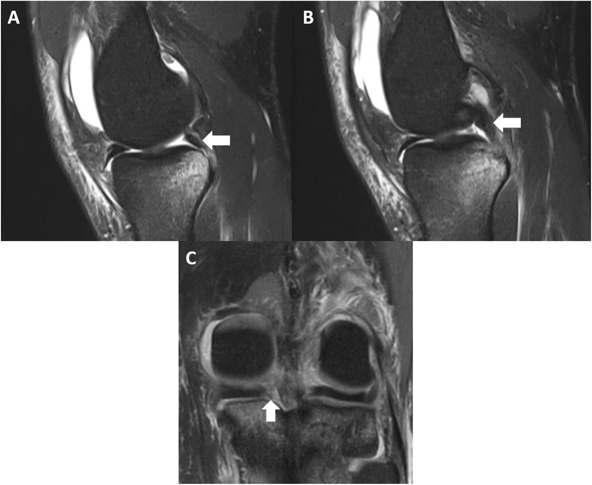 Diagnosis And Treatment Of Rotatory Knee Instability Springerlink