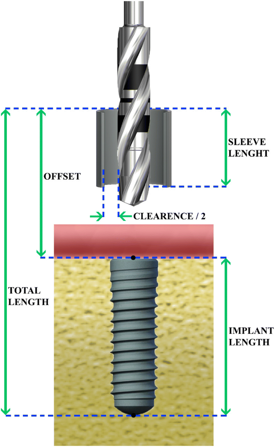 CAD/CAM implant surgical guides maximum errors in implant positioning