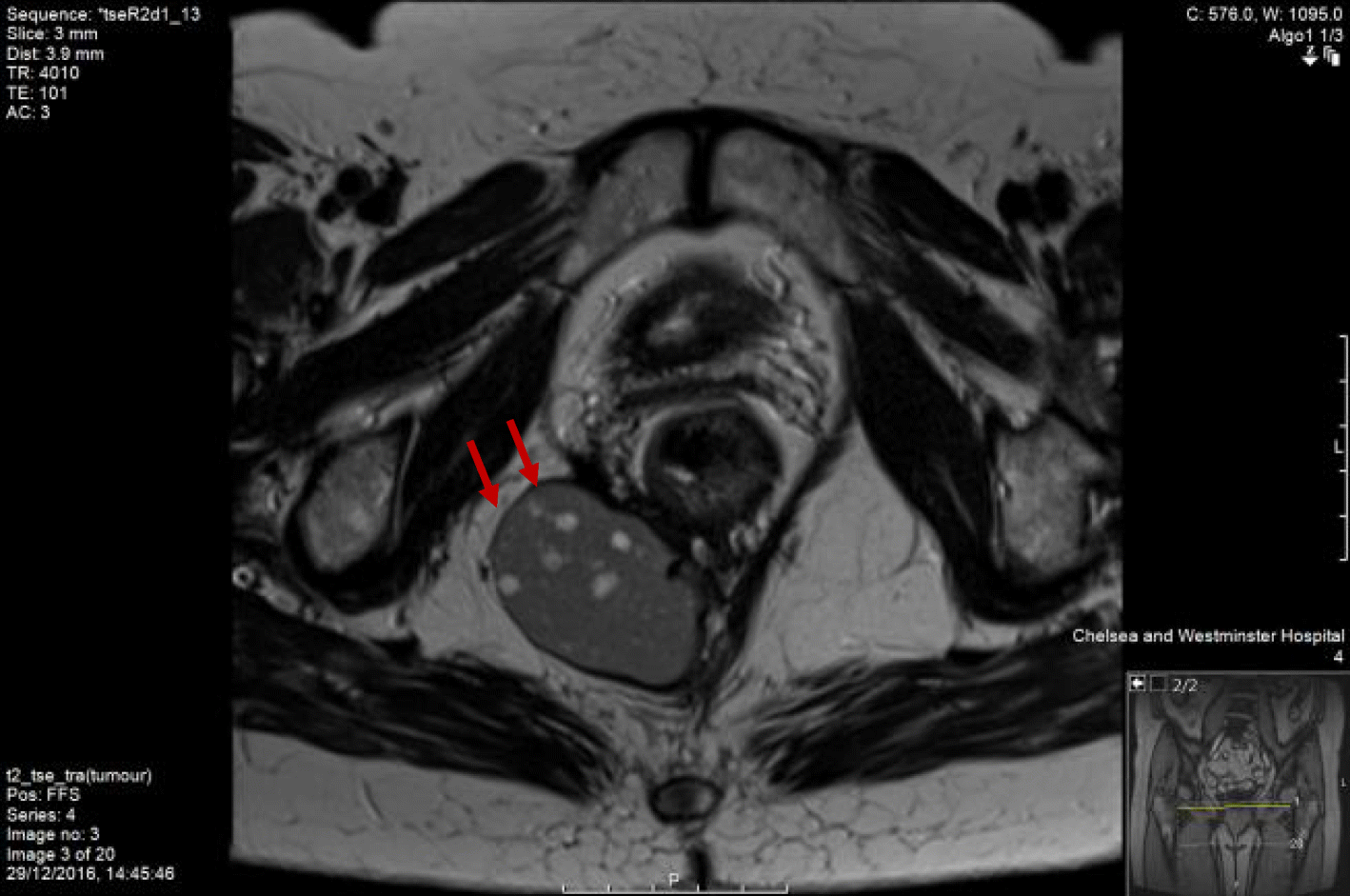 An unusual rectal duplication cyst SpringerLink