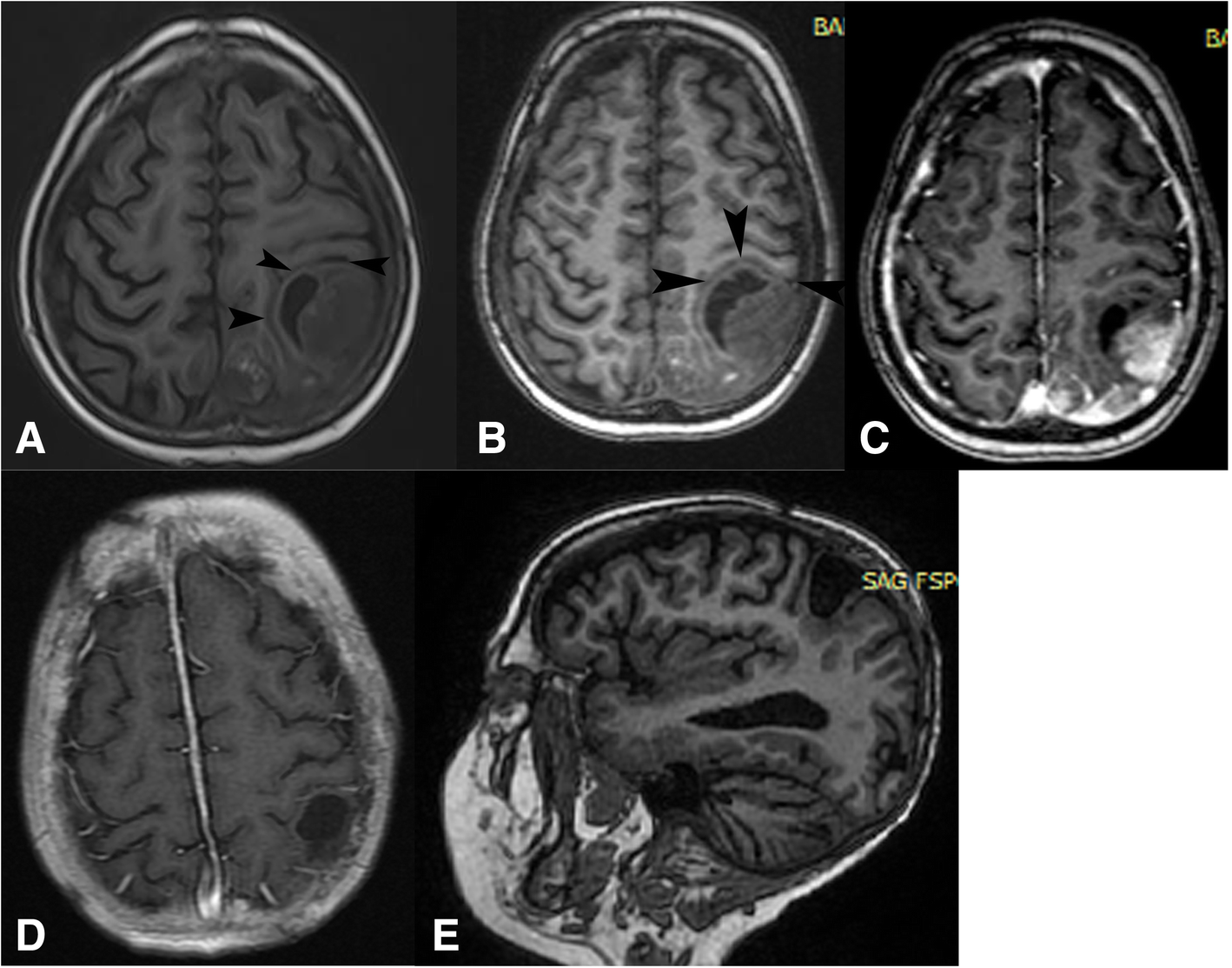 Trans Sulcal Or Fissure Approach For Supratentorial Brain - 