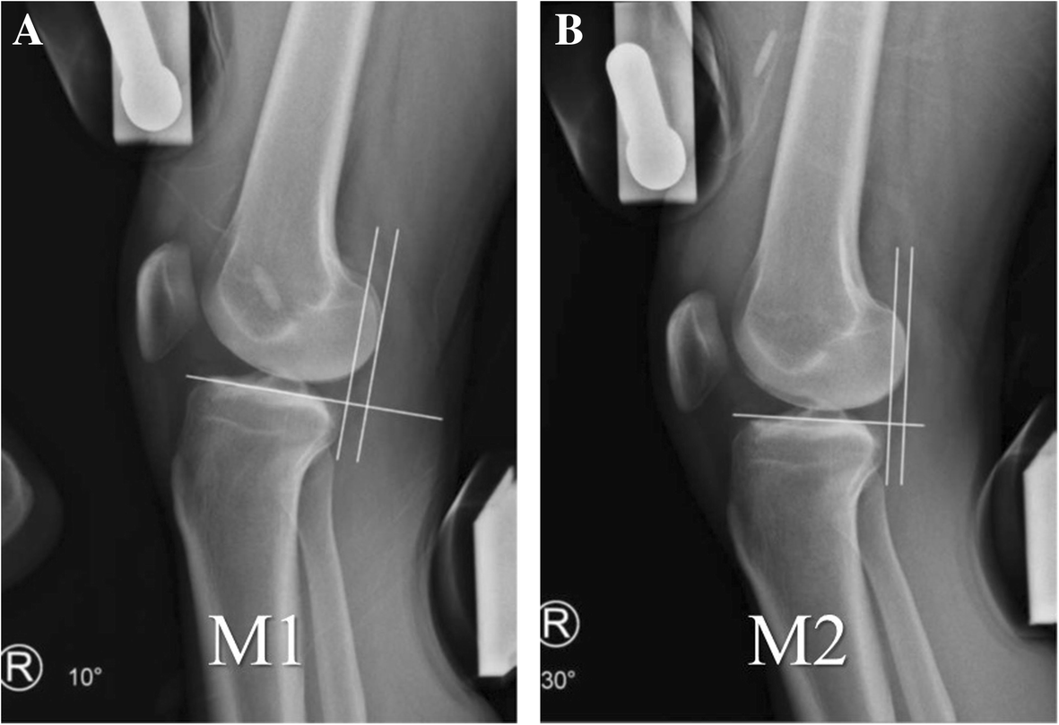 Anterior Tibial Displacement On Preoperative Stress Radiography Of