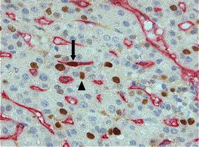Hepatocellular Carcinomas in Cirrhotic and Noncirrhotic Human Livers