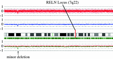 Reduced Expression Of Reelin Reln Gene Is Associated With High Recurrence Rate Of Hepatocellular Carcinoma Springerlink
